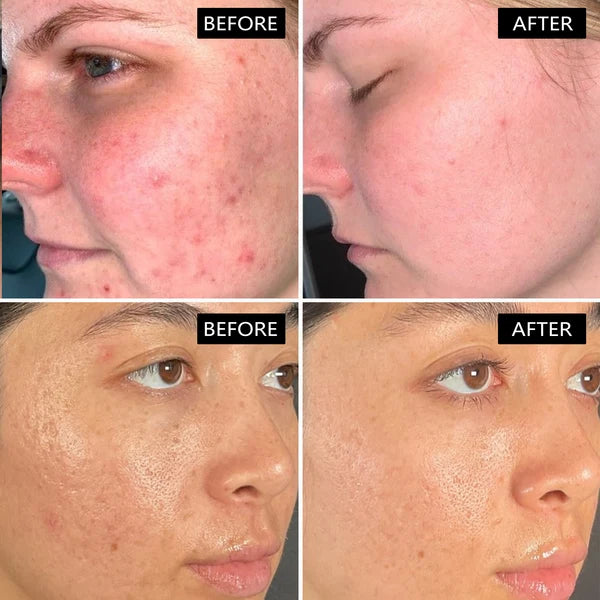 Beautyturess Komponita Acida Tea Argila Vezika Masko (Eksporta Stoko) 4g x 12 Paketoj